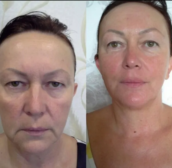 Миофасциальный массаж лица. Миофасциальный массаж лица что это такое.