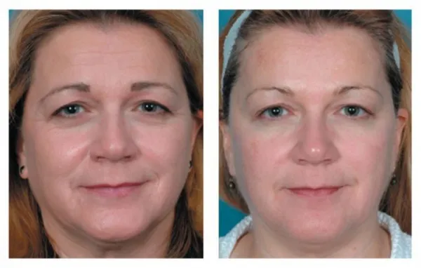 Миофасциальный массаж лица. Миофасциальный массаж лица что это такое.