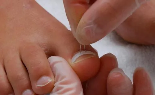 С какой скоростью растут ногти на ногах. За сколько времени отрастает удаленный ноготь?